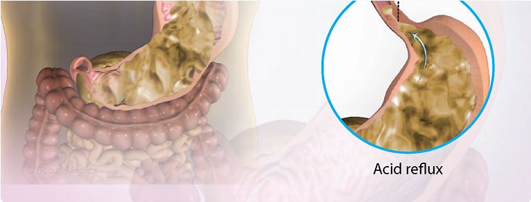 Symptoms and causes of Dyspepsia