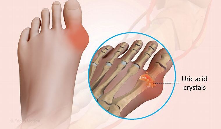 What is Gout ?