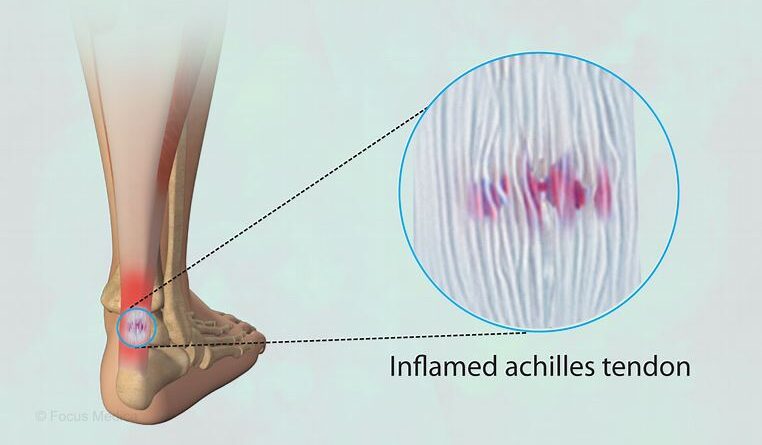 What is Achilles Tendonitis ?